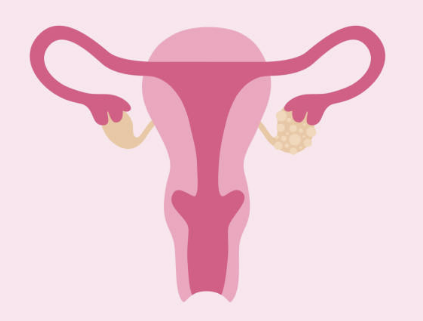 자궁근종 증상 크기별 치료 수술후 회복기간 등 알아보기(최신 Ver)