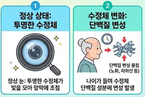 백내장 수술