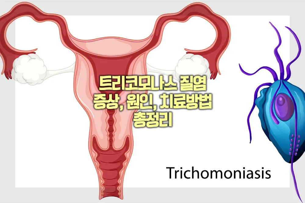 트리코모나스 질염 증상 원인 치료방법