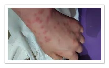 빈대 부작용