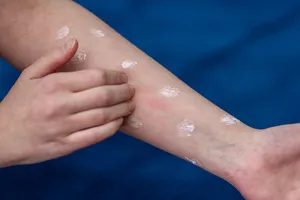 지루성-피부염-완치하려면