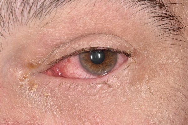 눈이 충혈되는 이유