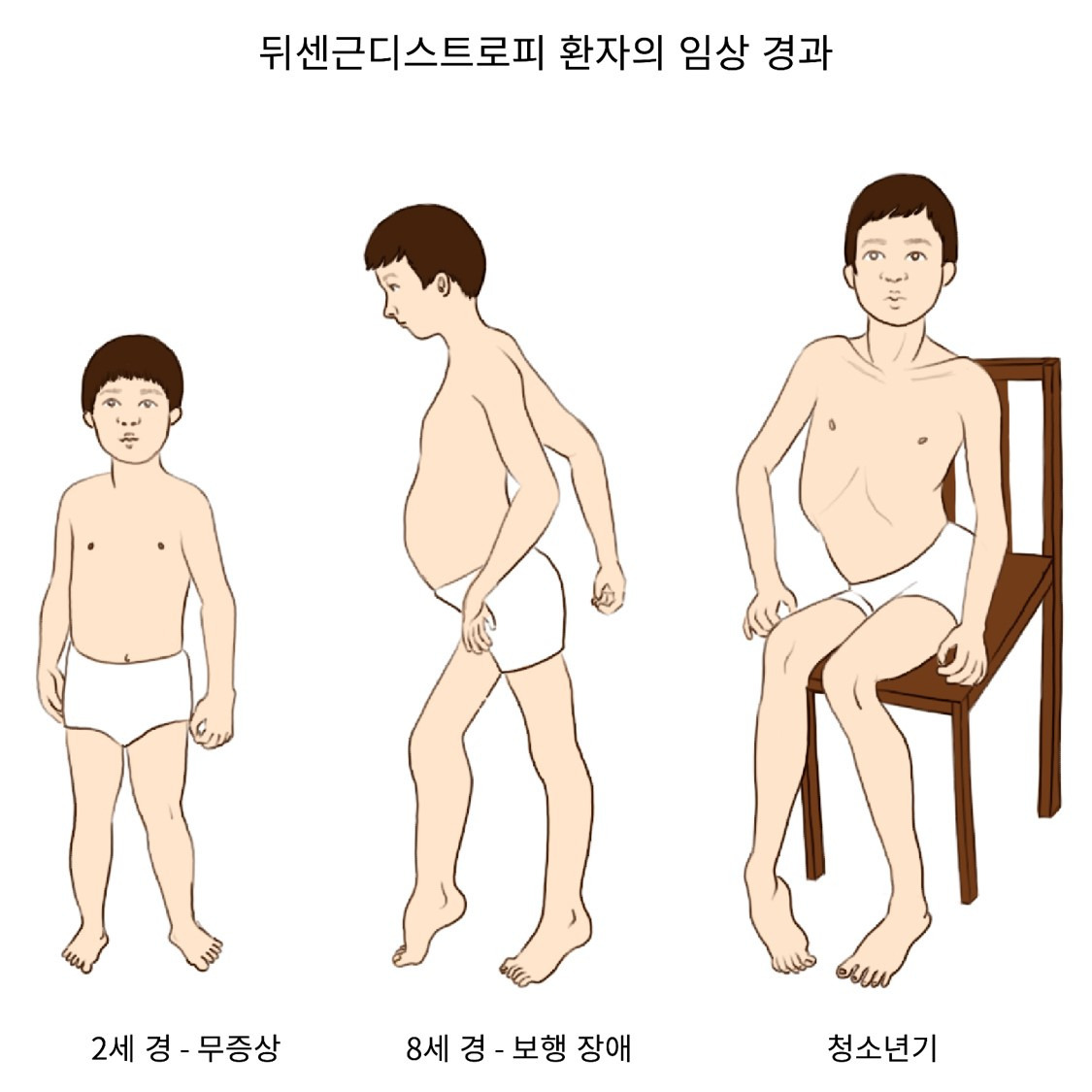 근이영양증 원인·증상·치료