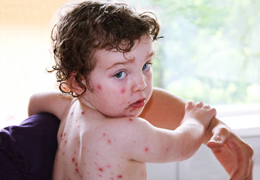 전염병 홍역 이미지