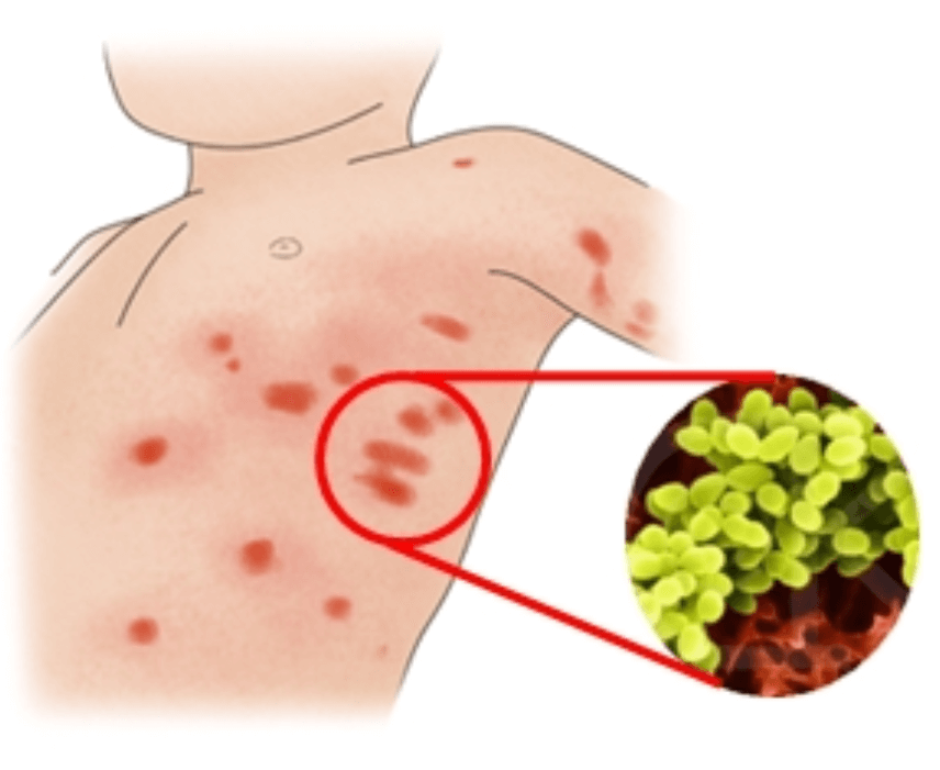 일본 감염병 연쇄구균 독성 쇼크 증후군 치사율 증상 예방법