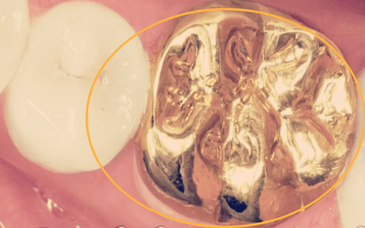 골드로-만든-치아-크라운