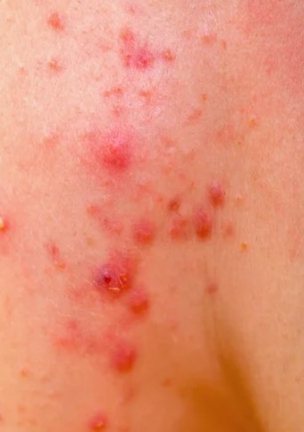 대상포진 초기증상 대상포진 조기치료 대상포진 초기증상 및 조기치료