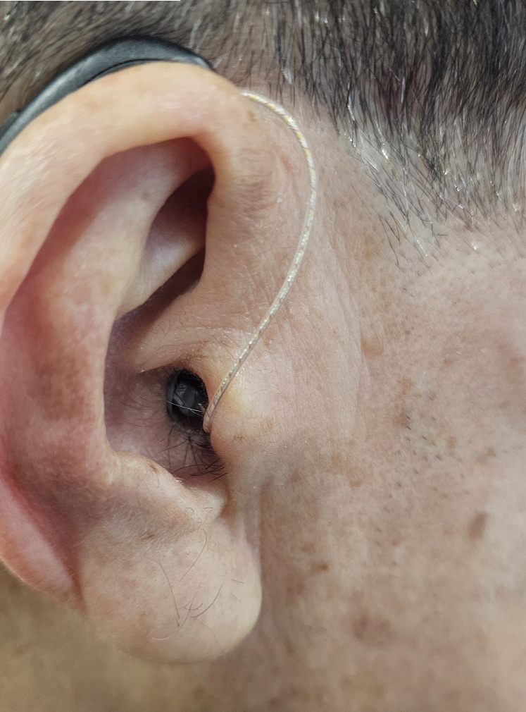 이명 보청기 착용사진 두번째