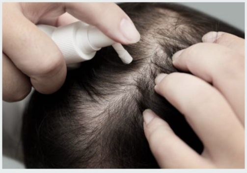 바르는 미녹시딜