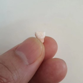 유치-과잉치-발치-사진