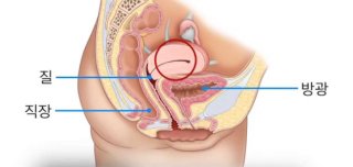 방광염 치료 방법