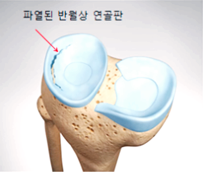 콘드로이친 효능 부작용