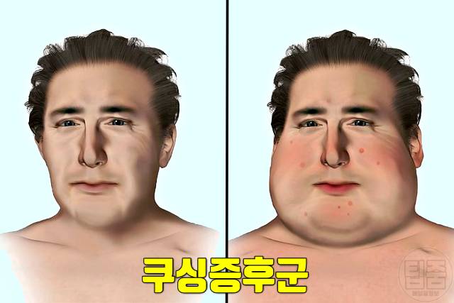귀밑 턱 부음 원인 쿠싱증후군 귀밑 턱이 부었어요