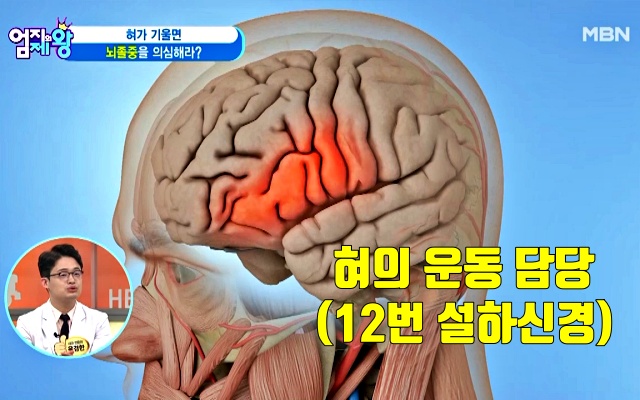 혀로 보는 뇌졸중 초기증상 자가진단, 혀 기울기, 혀 건강체크, 혀 건강상태, 건강 팁줌 매일꿀정보