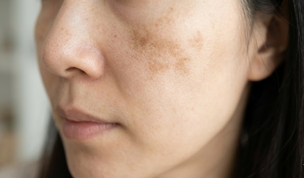 한국 여성의 광대뼈 주변에 퍼진 실제 기미와 작은 잡티들을 클로즈업한 사진