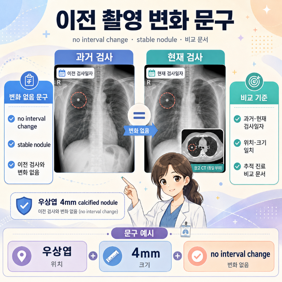 과거 검사와 현재 검사를 비교해 no interval change와 stable nodule 문구 의미를 설명하는 메디컬 인포그래픽 이미지