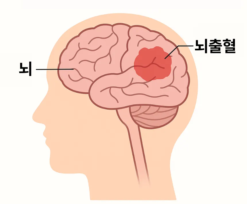 뇌출혈 초기증상
