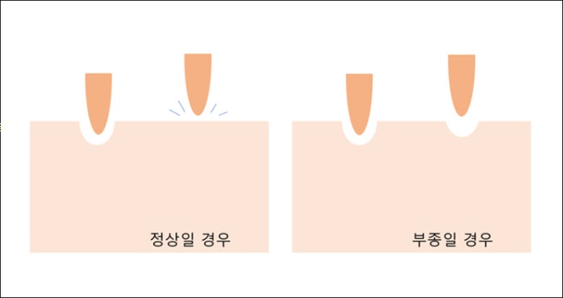 부종 증상