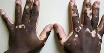 백반증 초기증상 5