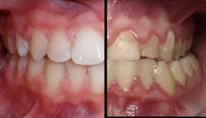 잇몸이 붓고 아플 때