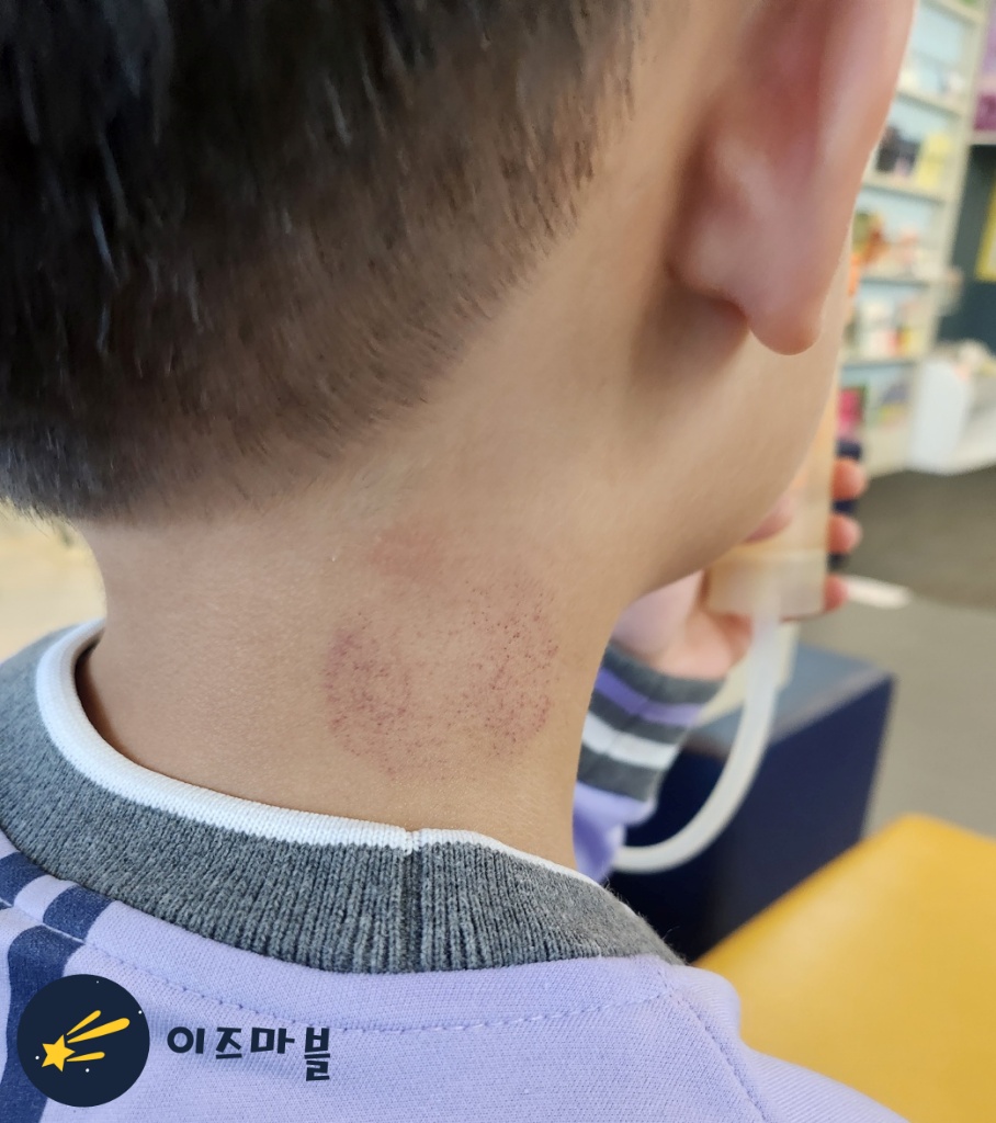 유아 담, 유아 근육통