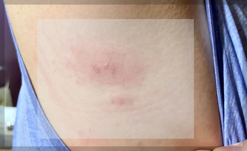 겨드랑이 대상포진