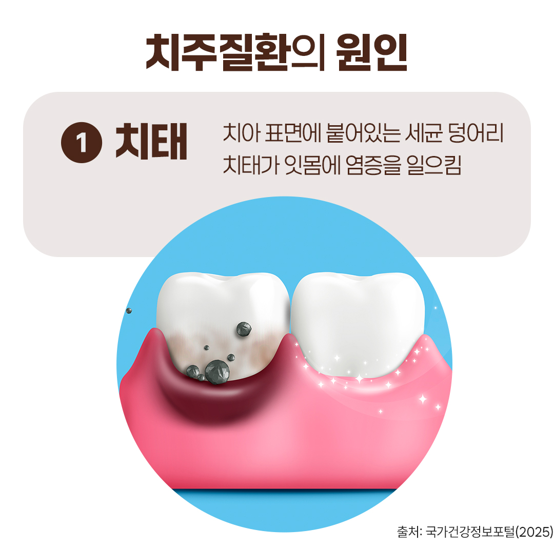 #치주질환의 원인 #치태