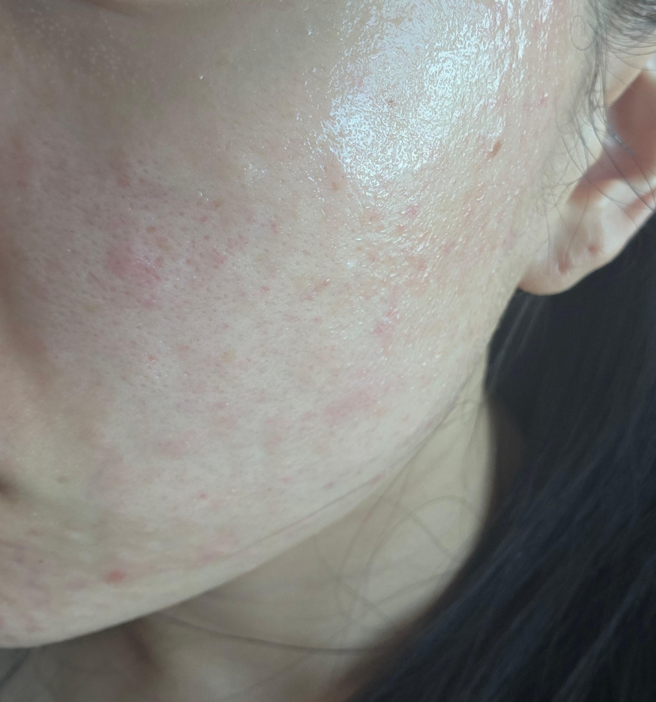 피부 붓기 3일차