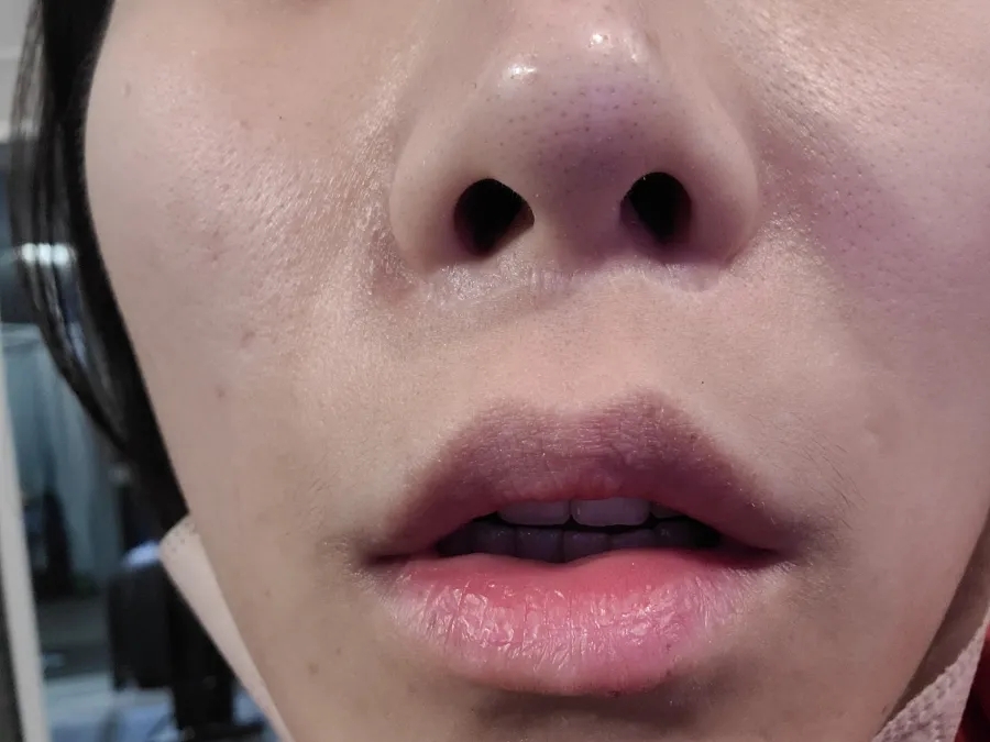 인중 축소 수술 후기