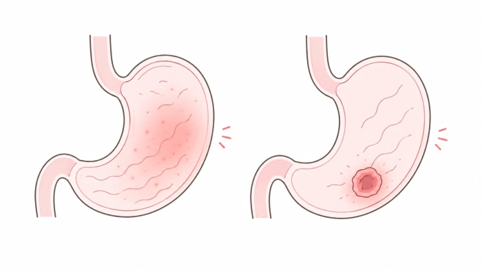 왼쪽 갈비뼈 아래 통증