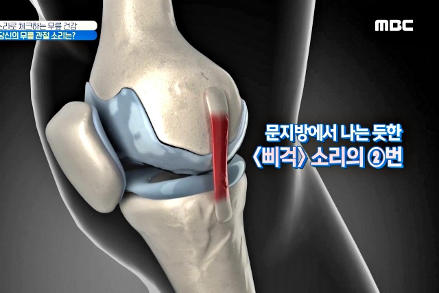 무릎에서 삐걱삐걱 소리 나는 이유, 앉았다 일어나면 무릎에서 소리가 나요, 무릎에서 소리나고 통증, 건강 팁줌 매일꿀정보