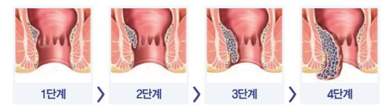 치질의 단계