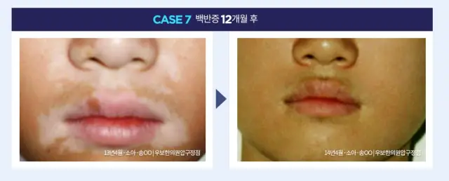 백반증 전문 우보환