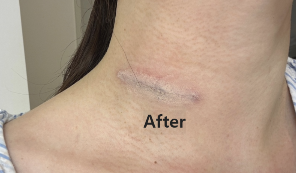 갑상선 암&amp;#44; 림프절 암 수술 흉터 관리 - 더마매직