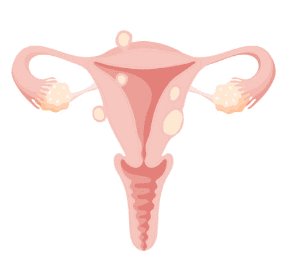 자궁근종 증상 7가지&amp;#44; 수술후 회복기간