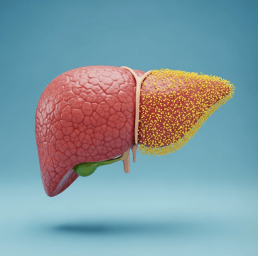 지방간 종류별 맞춤 관리법3