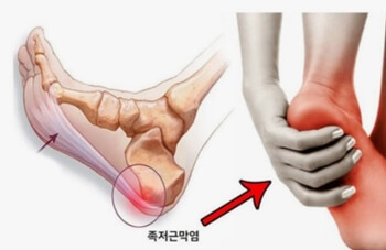 족저근막의 위치 족저근막염