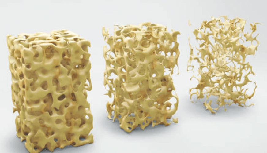 골다공증 검사비용