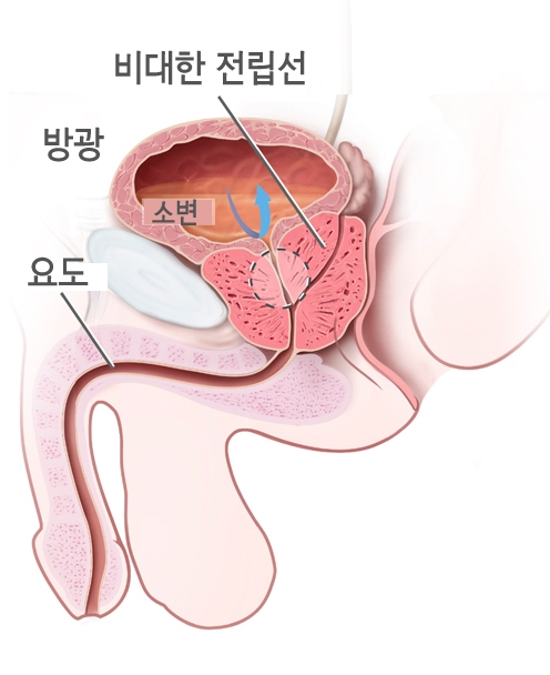 전립선 비대증