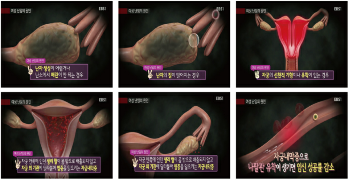 여성난임의 원인