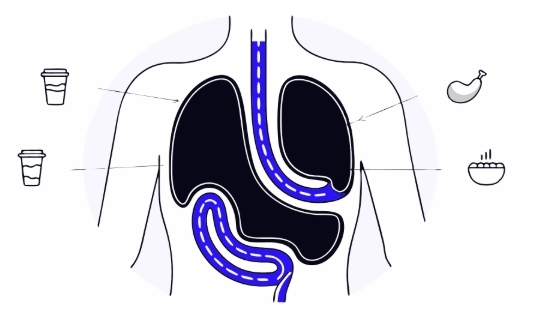 역류성식도염 치료 과정