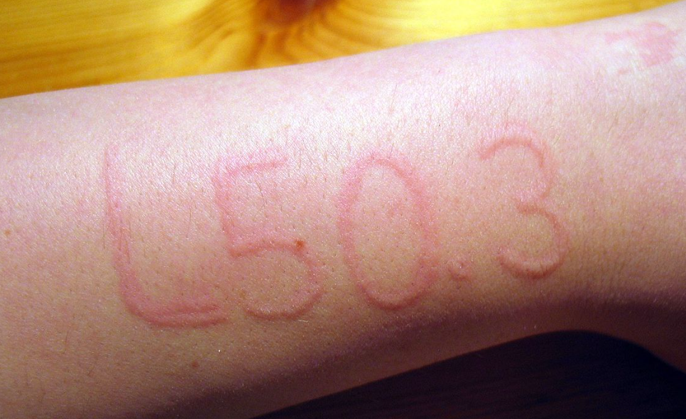 피부묘기증 대표 증상 이미지