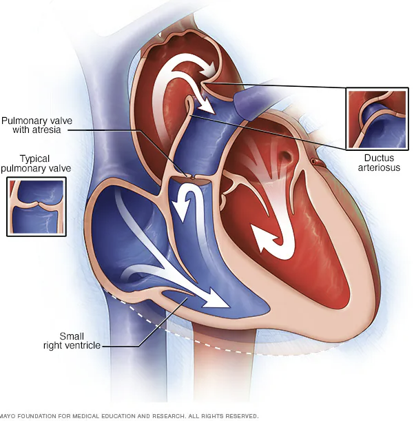 pulmonary atresia