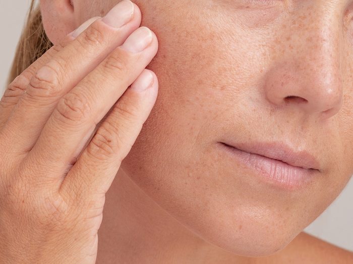 피부과 전문의가 추천하는 기미 없애는 방법