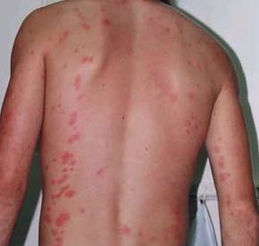 빈대에 물렸을 때 모습