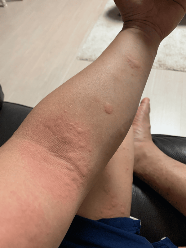 팔-두드러기증상