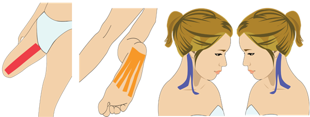 불면증 완화를 위한 테이핑 요법