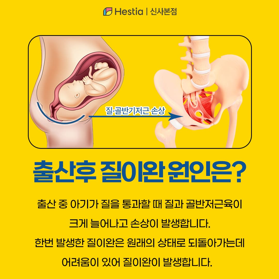 출산후 질이완 원인은?
