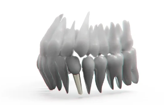 임플란트 종류와 재료