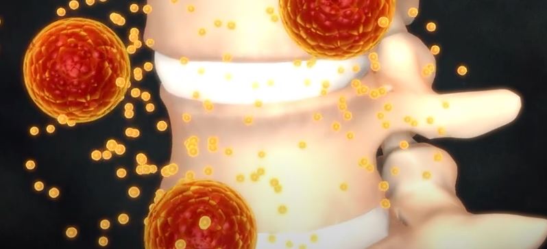 급성 횡단성 척수염